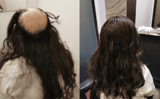Hair Replacement Singapore